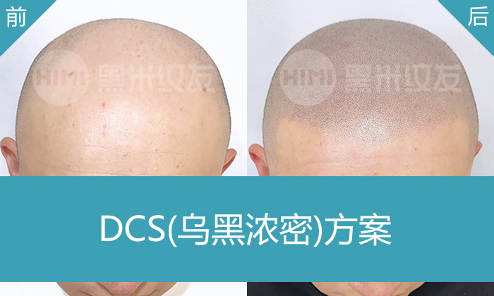 焦先生脱发10年大面积秃头，在沈阳黑米纹发从秃头变浓密寸头