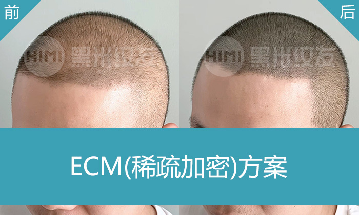 李先生脱发8年头发整体稀疏，在广州黑米纹发从稀疏变浓密