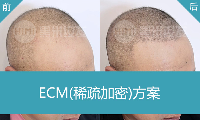 其先生脱发8年M型发际线后移头顶稀疏，在重庆黑米纹发修复发际线头顶稀疏