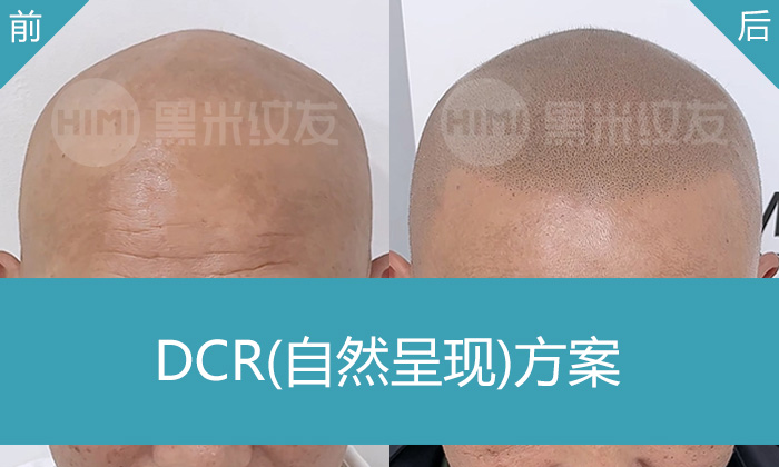 李先生脱发光头20年,在重庆黑米纹发变身浓密寸头年轻10岁