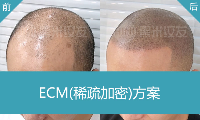 姜先生脱发5年M角后移头顶稀疏，在武汉黑米纹发变浓密寸头