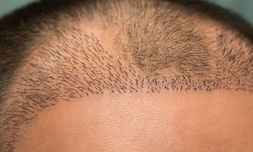 植发失败后选择纹发的解决方案