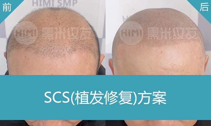 黄先生脱发10年植发失败头顶稀疏,在武汉黑米纹发变浓密寸头形象