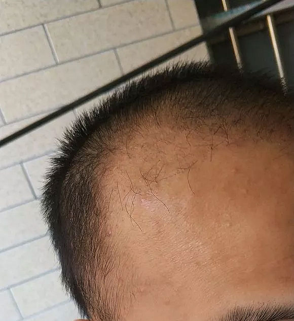 额角脱发选择植发，结果植发失败，额角稀疏
