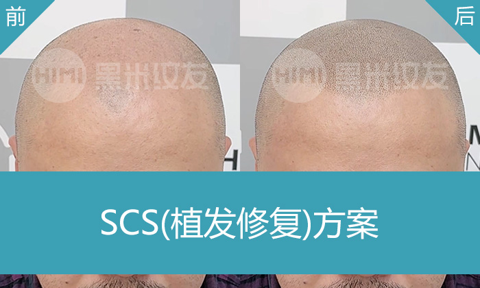 鞠先生脱发10年植发失败，在重庆黑米纹发补救头顶稀疏纹发变浓密