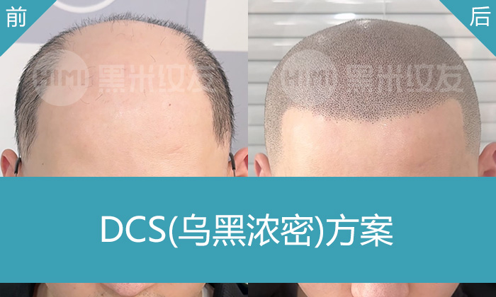武汉秃顶纹发哪家好？黑米纹发案例_潘先生秃顶变浓密寸头