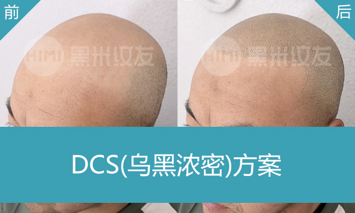 左先生秃顶10年变寸头！长春黑米纹发真实案例：1次操作重获年轻浓密形象