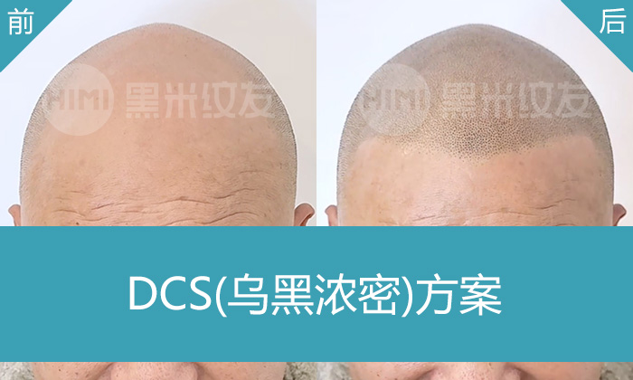 重庆黑米纹发成功案例：彭先生告别15年脱发秃头，重获浓密寸头新形象