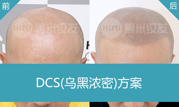罗先生15年脱发被解决，重庆黑米纹发秃头纹发寸头方案效果实拍