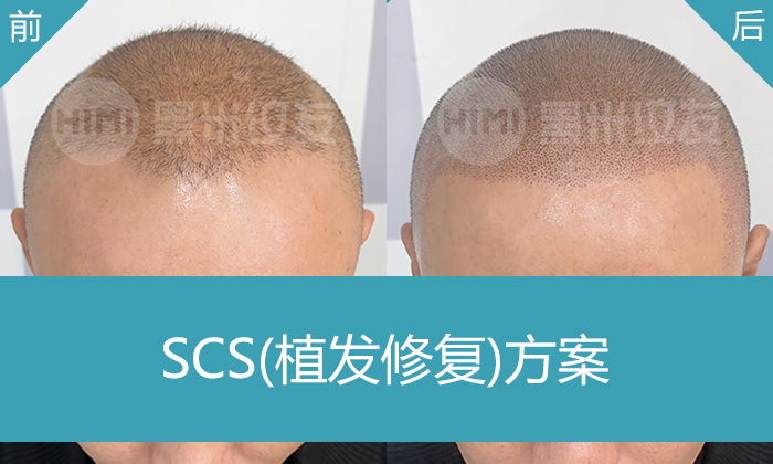 植发失败头顶稀疏怎么办？重庆黑米纹发修复案例：8年脱发关先生重获浓密寸头