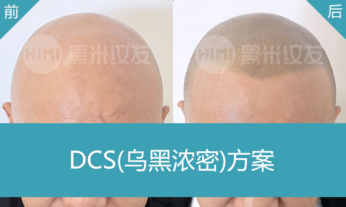 胡先生脱发15年光头，在重庆黑米纹发光头变寸头，重拾年轻自信形象