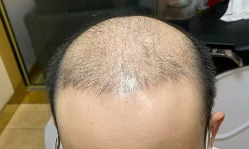 植发失败该怎么面对现实？纹发助力重拾浓密秀发