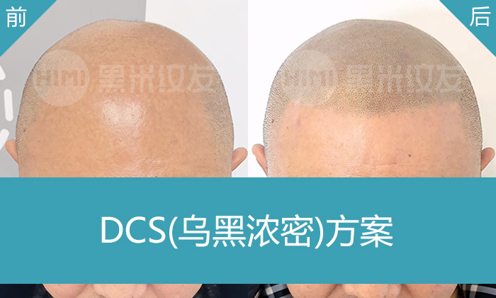 严重秃顶变年轻5岁！重庆黑米纹发15年脱发者申先生真实蜕变案例