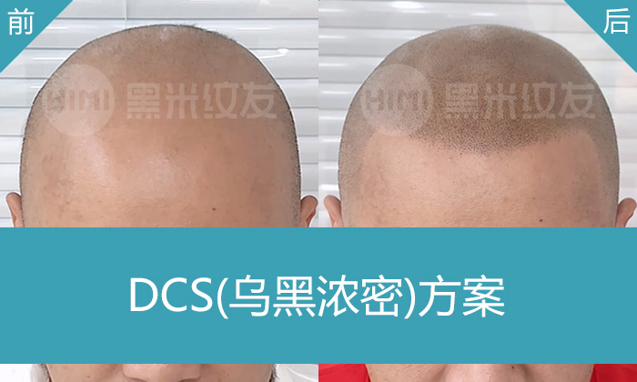 秃头十年无解？陈先生武汉黑米纹发逆袭浓密寸头，重获年轻形象