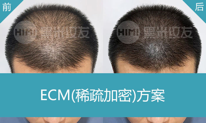 沈阳黑米纹发ECM稀疏加密方案 —— 夏先生8年精神性脱发逆袭记