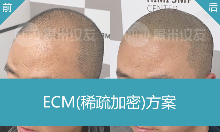 孟先生额头M角后移、头顶稀疏到自信浓密发型 - 黑米纹发北京真实案例