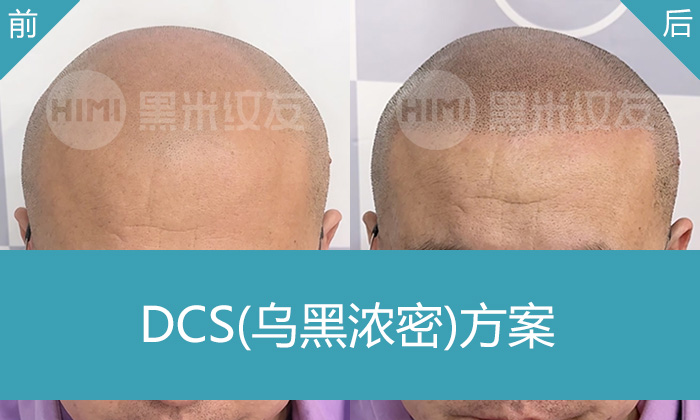 秃顶纹发真实案例 | 张先生从稀疏到浓密寸头蜕变 | 黑米纹发武汉店