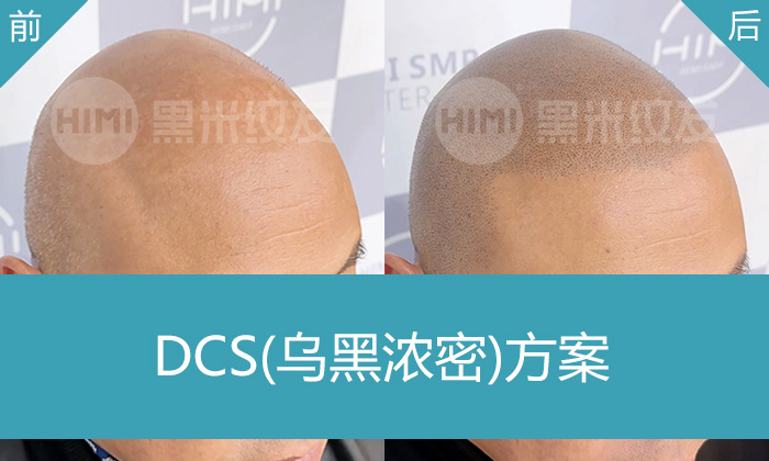 肖先生脱发秃头纹发真实案例_武汉黑米纹发解决秃头前后对比