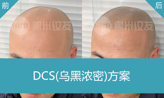武汉黑米纹发案例｜发际线后移+头顶稀疏修复，陈先生纹发后惊喜蜕变