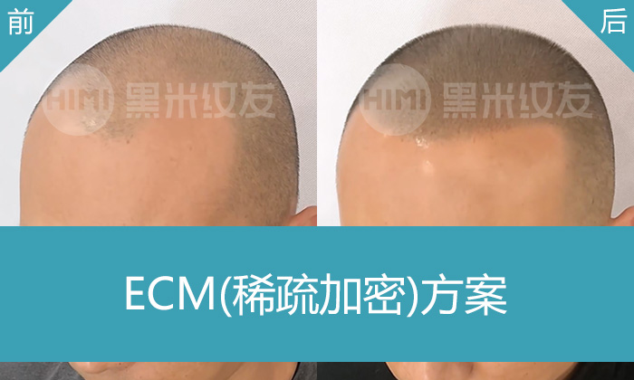 济南黑米纹发案例｜单先生M角发际线+头顶稀疏修复，3小时重塑浓密发量