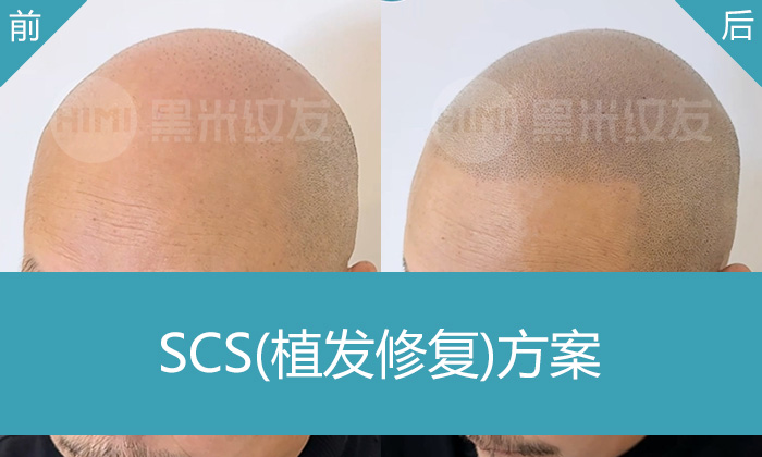 侯先生20年脱发困扰-植发失败修复案例-重庆黑米纹发真实效果展示