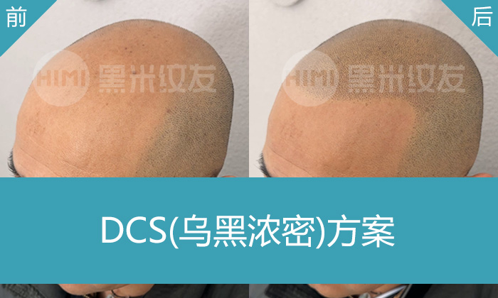 秃顶多年刘先生通过纹发重获浓密寸头，长春黑米纹发真实效果对比