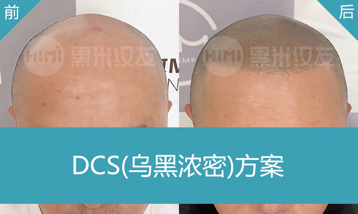 广州黑米纹发案例：秃顶多年利先生，纹发后变身浓密寸头｜真实效果