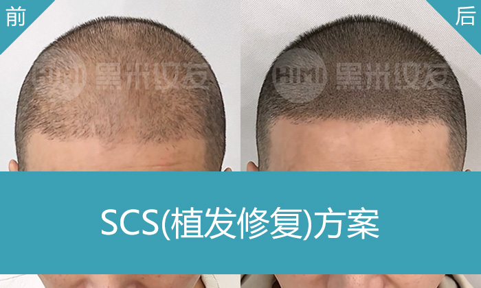 植发失败修复真实案例_秦先生发际线头顶加密纹发经历_黑米纹发济南店