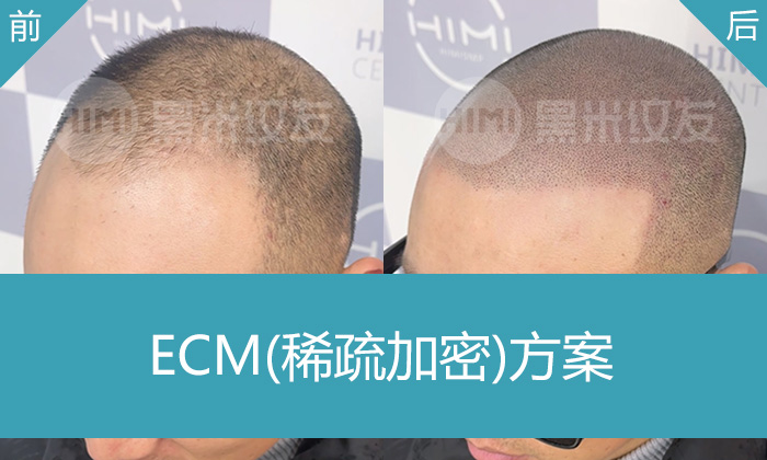 武汉黑米纹发为刘先生解决多年脱发发际线后移困扰，M角修复+头顶加密