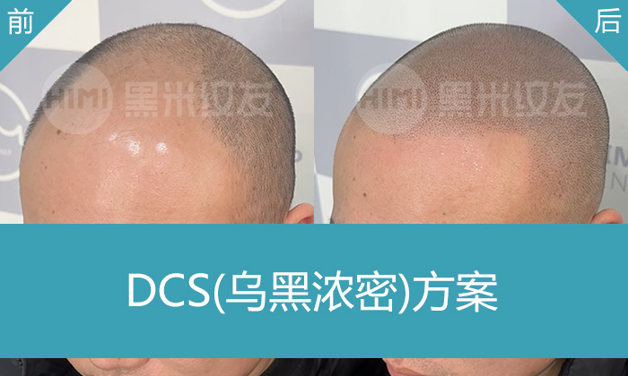 刘先生秃顶变浓密寸头，5年脱发困扰终结！武汉黑米纹发见证