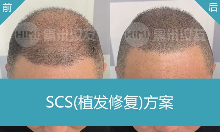 植发失败修复新选择｜武汉黑米纹发助力刘先生告别植发失败头顶稀疏