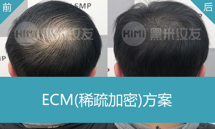 重庆头顶发旋稀疏纹发加密案例｜米诺地尔无效者邱先生纹发效果实录