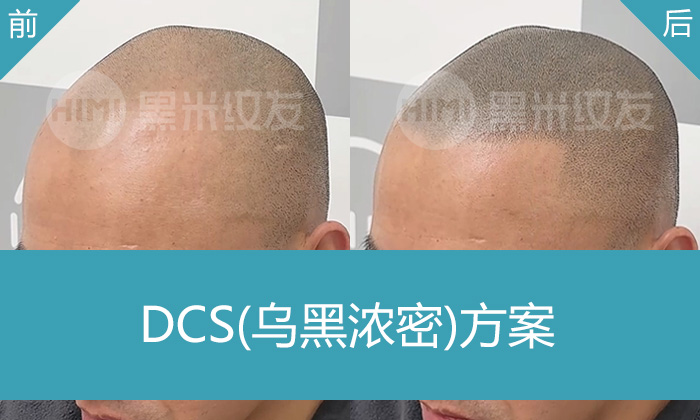 雄脱救星！重庆黑米纹发助杨先生重获浓密寸头，年轻5岁不是梦