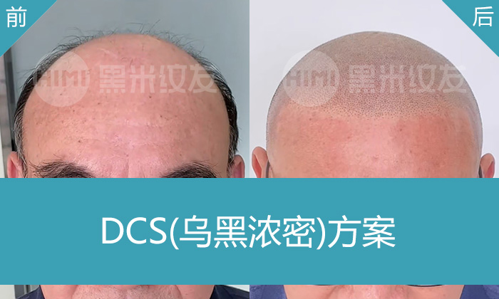 广州李先生秃顶变寸头真实案例｜纹发后形象大变显年轻