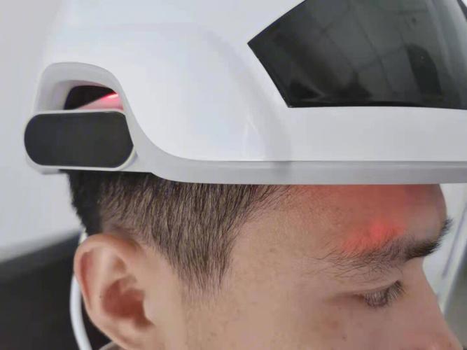 25岁的小李因雄激素性脱发选择药物治疗+激光治疗