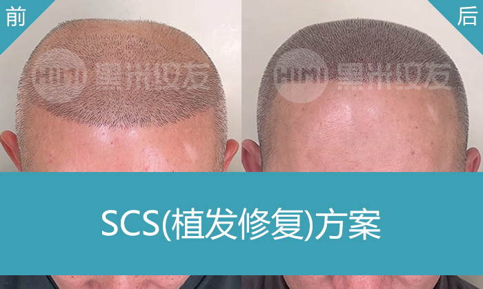 植发后头发稀疏怎么办？林先生10年脱发经历分享-黑米纹发加密技术