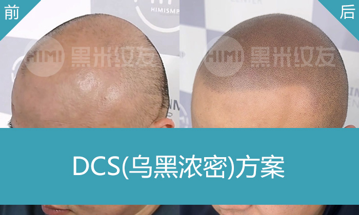 5年秃顶变浓密寸头 | 王先生脱发救星，武汉黑米纹发真实案例