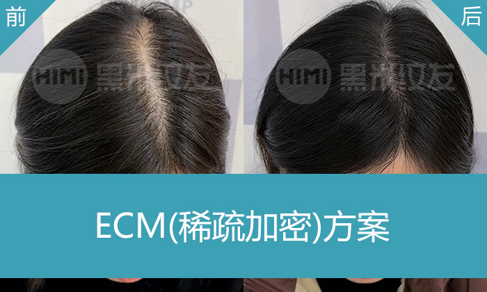 发缝越来越宽怎么办？武汉赵女士纹发加密经历分享-黑米纹发改善女性脱发