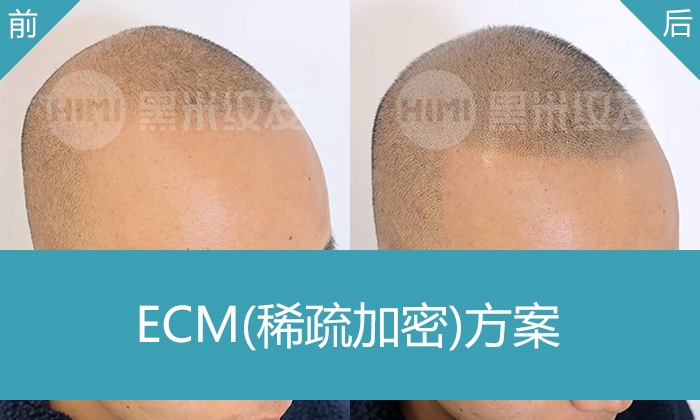 头顶稀疏严重纹发效果怎么样？重庆杨先生5年困扰真实改变