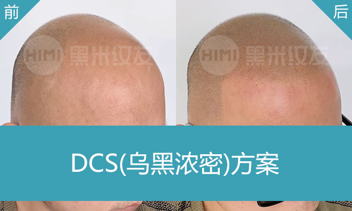 广州黄先生10年脱发终解决，1次操作让秃顶变寸头形象