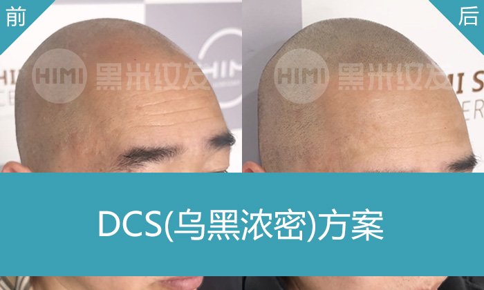 韦先生M型脱发10年终改变！广州黑米纹发秃顶变浓密寸头，效果惊艳