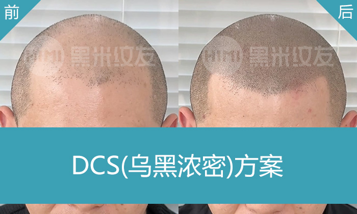 赵先生8年脱发从秃顶到浓密寸头，武汉黑米纹发真实效果展示