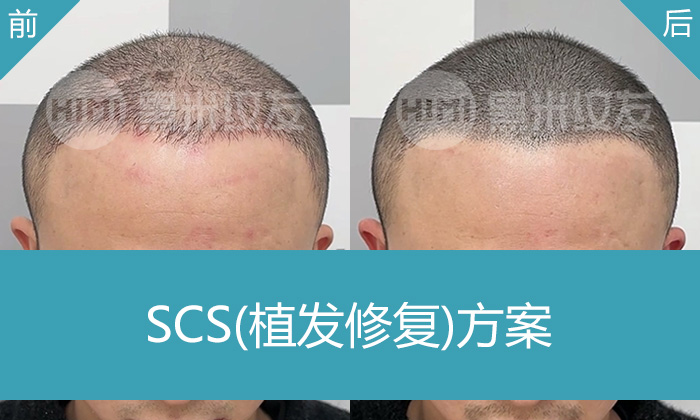 植发失败不用愁！重庆黑米纹发助魏先生解决7年脱发难题