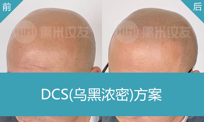 许先生10年脱发困扰，纹发后变浓密寸头真实案例｜广州黑米纹发