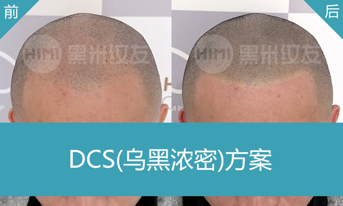 梁先生5年脱发M型发际线+头顶稀疏，在广州黑米纹发逆袭成帅气寸头