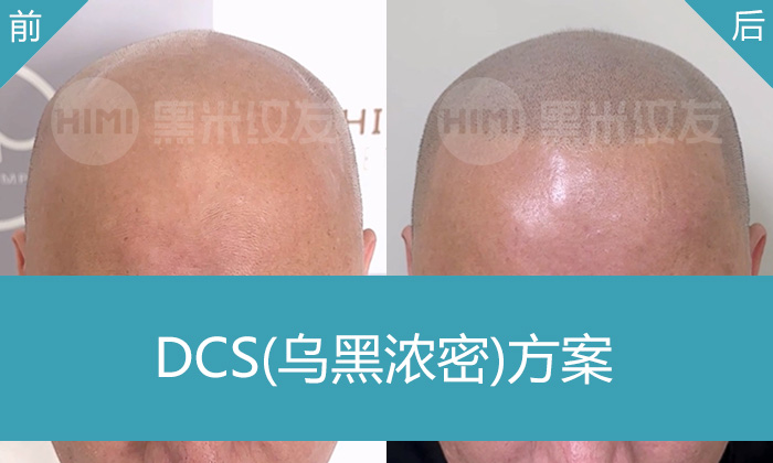 吴先生10年秃顶终获救！广州黑米纹发真实案例见证奇迹