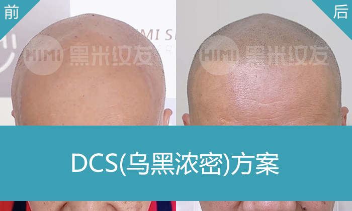 秃顶变浓密寸头！广州黑米纹发助侯先生10年脱发难题一朝解决