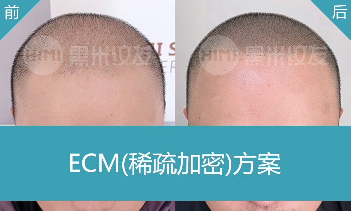 药物治疗5年无效？尹先生头顶稀疏发际线后移，看广州黑米纹发如何改变形象