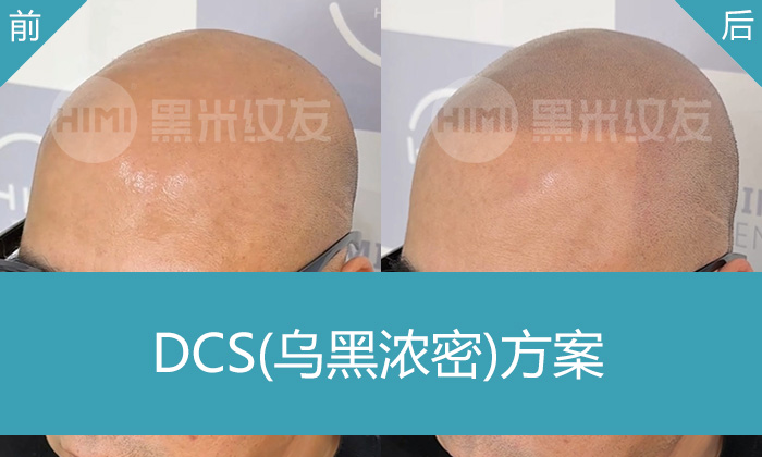 脱发严重没自信怎么办-黑米纹发前后对比效果图 脱发严重没自信怎么办-黑米纹发前后对比效果图