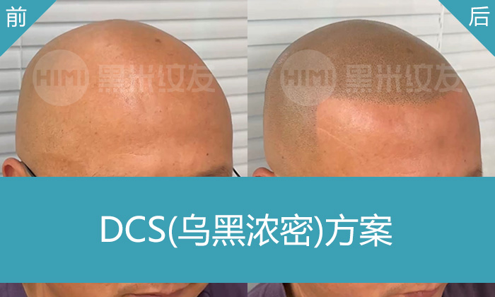 12年秃顶变浓密寸头！武汉黑米纹发助王先生重获年轻形象